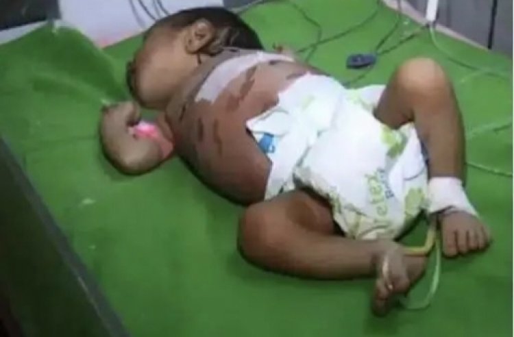 பிறந்து 1 மாதமேயான குழந்தைக்கு 40 முறை சூடு வைத்த கொடூரம்.!